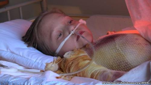 Постраждалий під час віялових відімкнень 10-річний черкащанин потребує ще кількох операцій