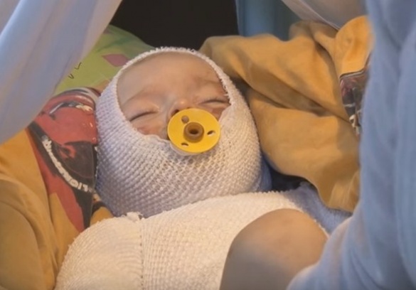 Черкаські лікарі врятували малюка з опіками (ВІДЕО)